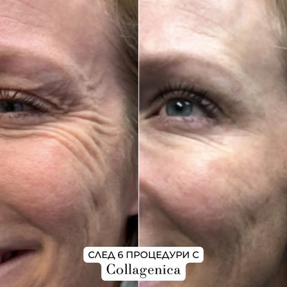 Collagenica – Анти-Ейдж микронидлинг система за дълбоко подхранване и регенериране на кожата