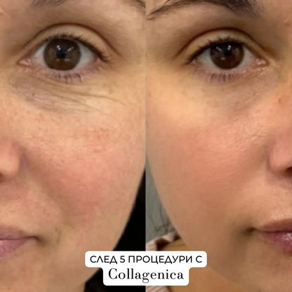Collagenica – Анти-Ейдж микронидлинг система за дълбоко подхранване и регенериране на кожата