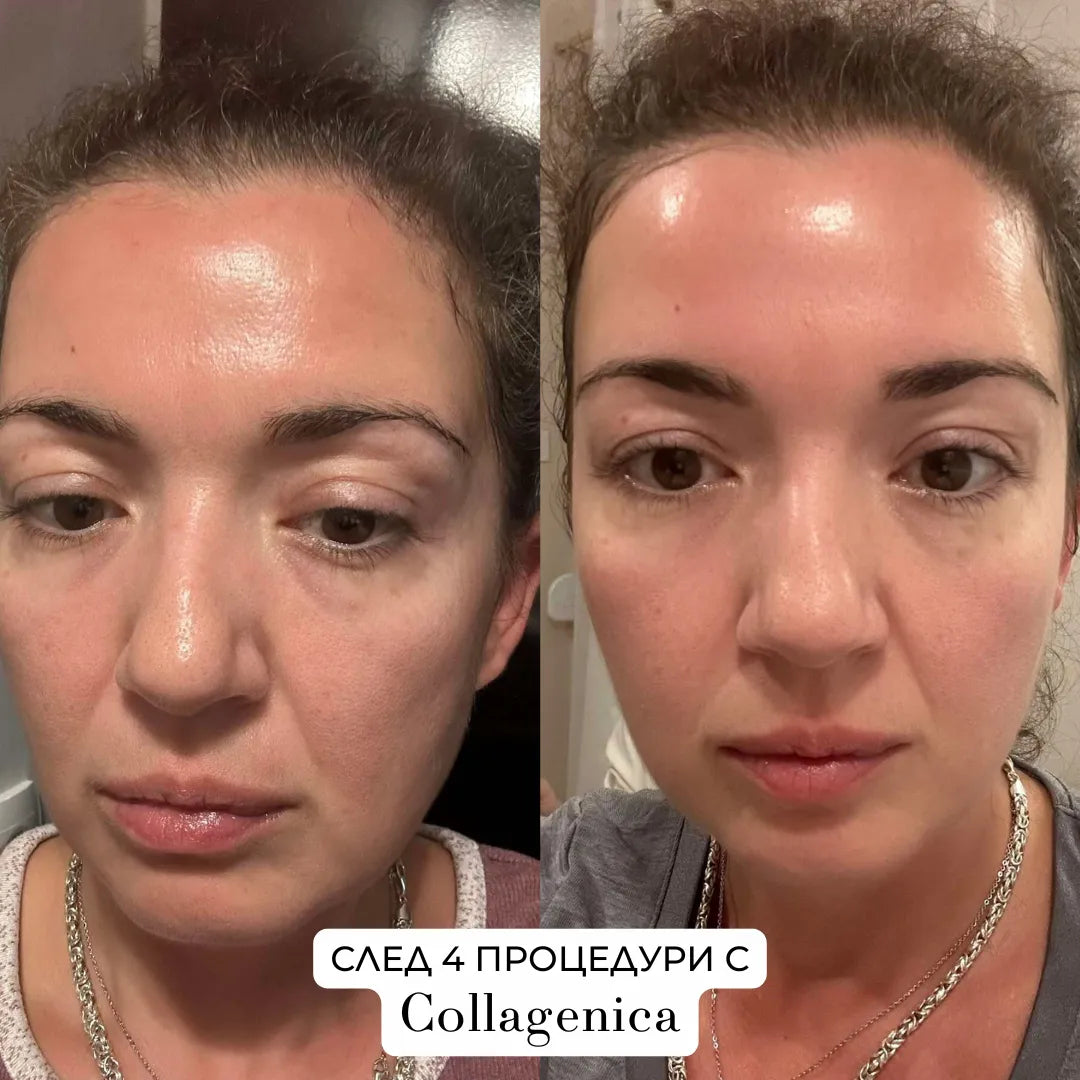 Collagenica – Анти-Ейдж микронидлинг система за дълбоко подхранване и регенериране на кожата